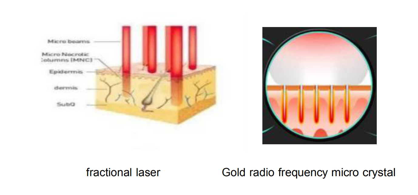 laser difference